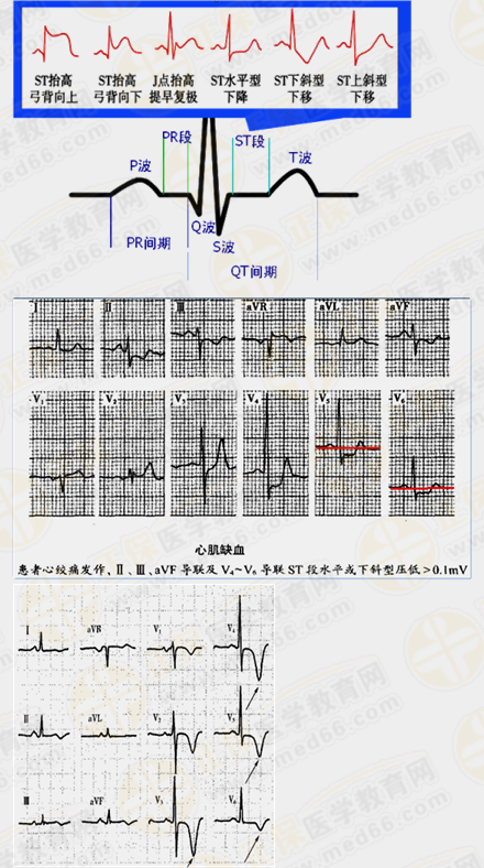 心肌缺血心電圖特點(diǎn)