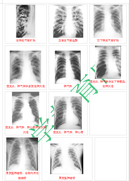 快收藏！臨床助理醫(yī)師實踐技能62個胸片（圖片診斷）