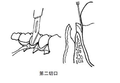 翻瓣術