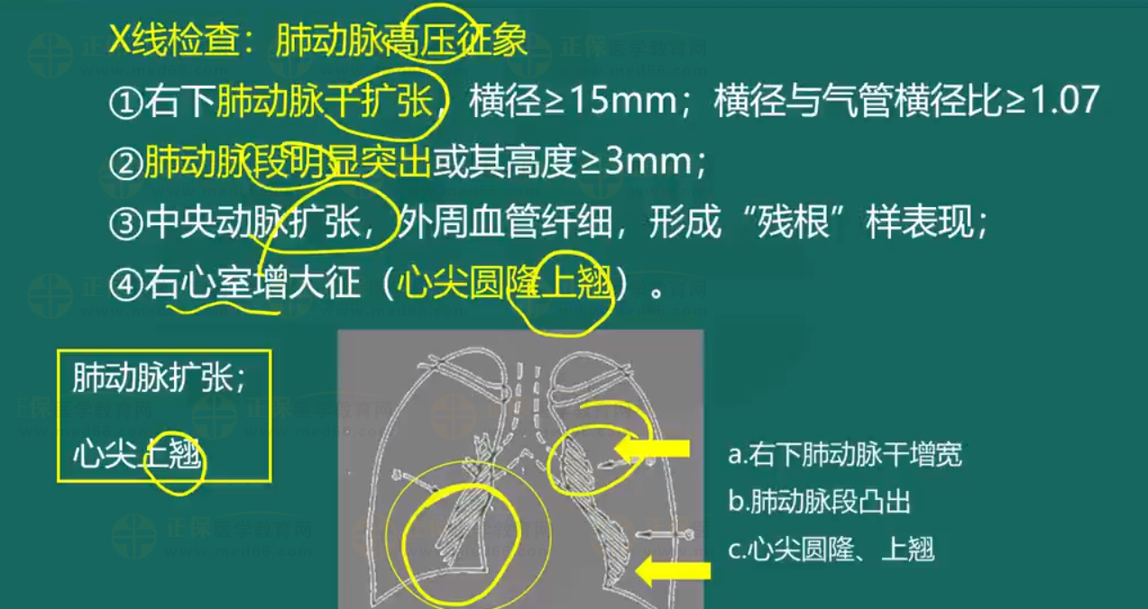 慢性肺源性心臟病-2